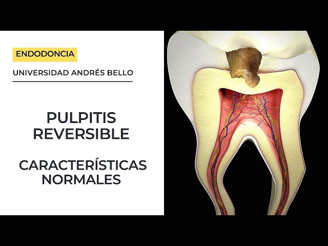 REVERSIBLE PULPITIS - Normal Characteristics