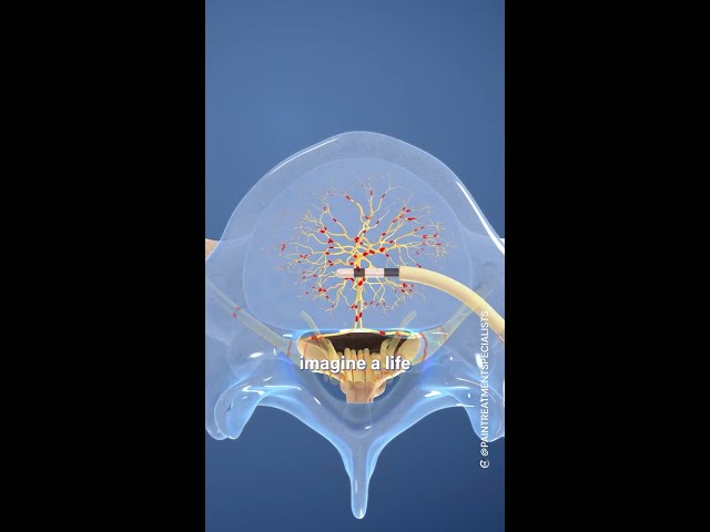 Intracept treatment for pain management