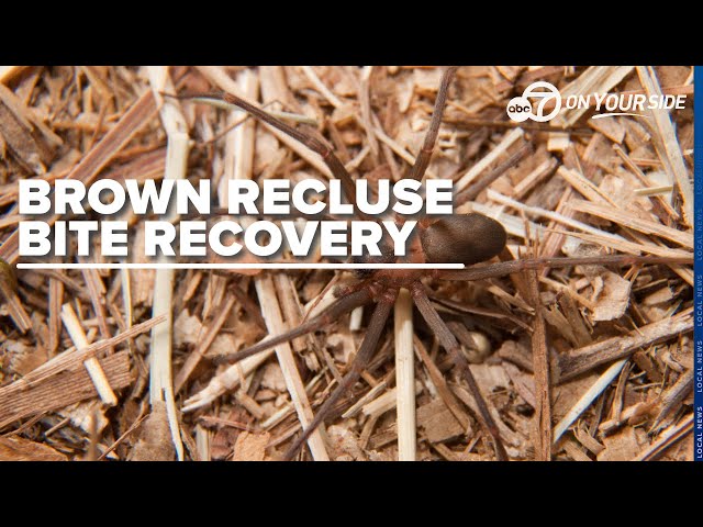 Arkansas girl recovering after life-threatening bite from brown recluse