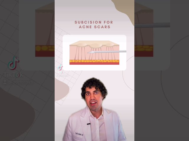 Learn More About Subcision Treatment for Acne Scars By Dr. Nadir Qazi