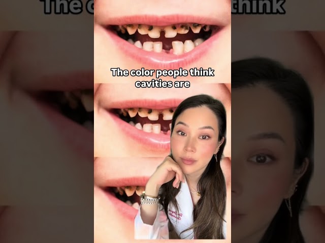 What a cavity actually looks like. #cavity #cavities #decay #dentist #cosmeticdentist #filling