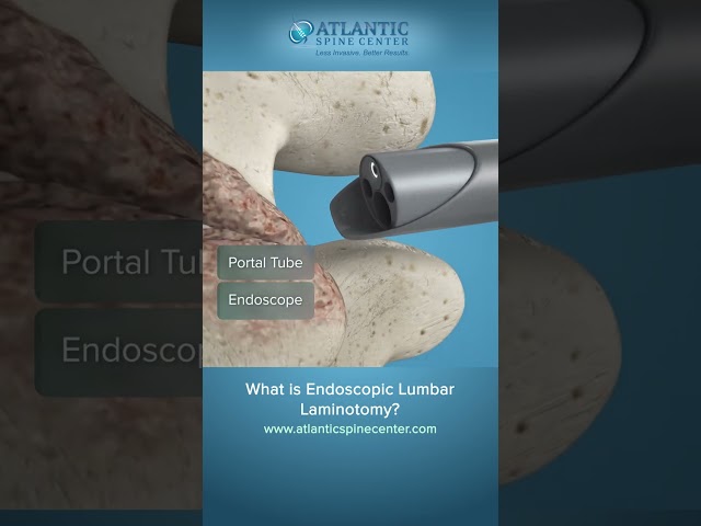 Not all spine procedures require large incisions.