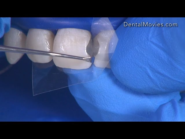 Class 3 composite restoration