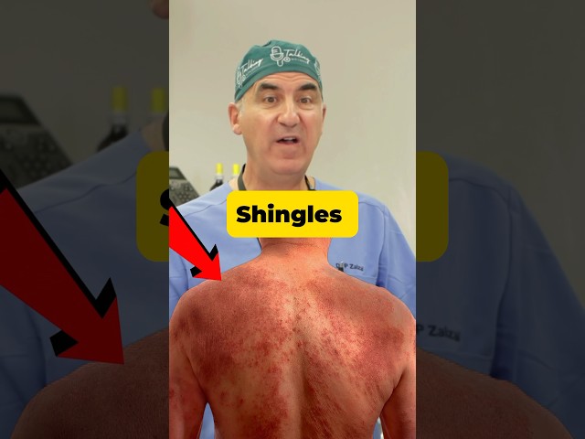 Shingles - You Don't Want This! #shorts