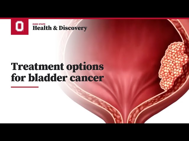 Treatment options for bladder cancer  | Ohio State Medical Center
