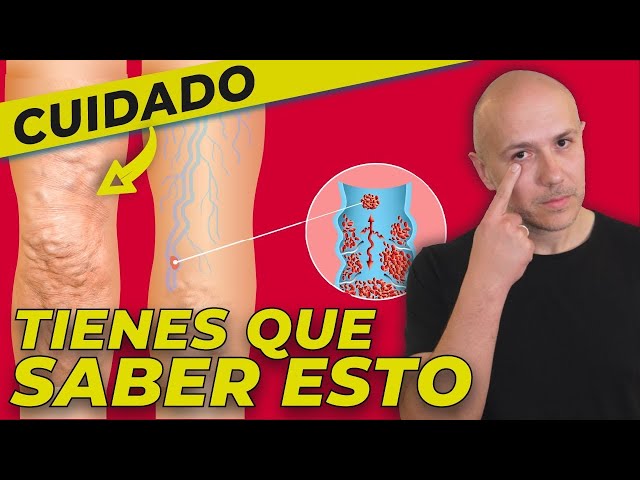 COMBATE LAS VARICES Y LOS TROMBOS EN LAS VENAS | MEJORA LA MALA CIRCULACIÓN DE LAS PIERNAS