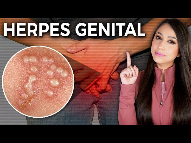 Why does HERPES have no cure? l Genital herpes: Cause, symptoms and TREATMENT👩🏻‍⚕️ @DraPauZuniga