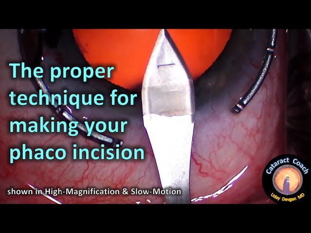 Close Up: Technique for Phaco Incision in Cataract Surgery