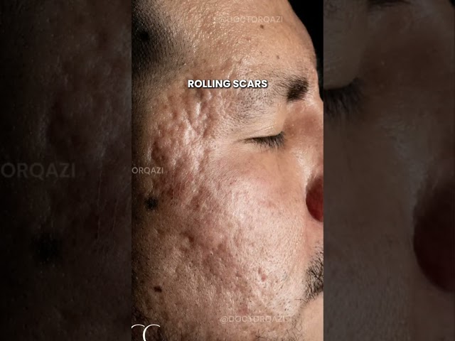 Why Acne Scar Treatments Must Be Custom to Your Skin!! #SkinRestoration