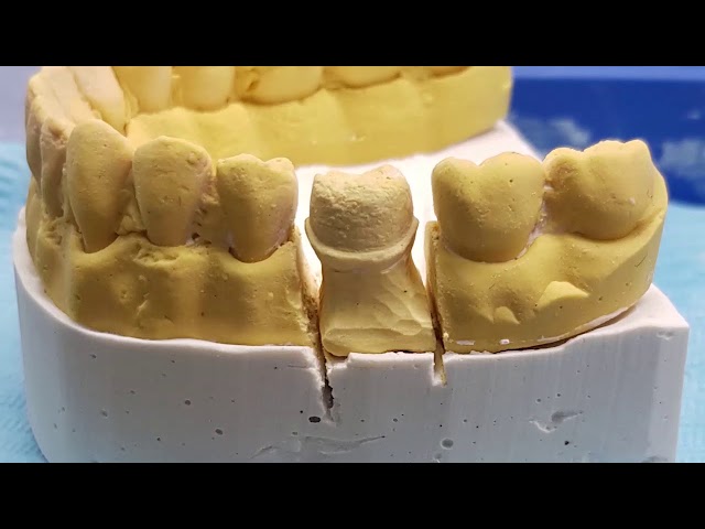 Full metal crown lost wax technique