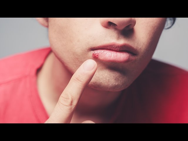 Dermatologist explains causes of cold sores