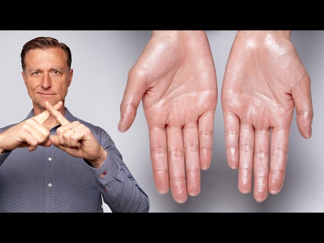How to Stop Excessive Sweating (Hyperhidrosis)