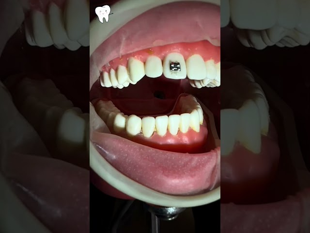 🎥 Cementado de brackets y colocación del arco + retirada de brackets 🔥 #ortodoncia #bracket