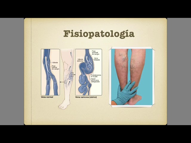 Deep vein thrombosis