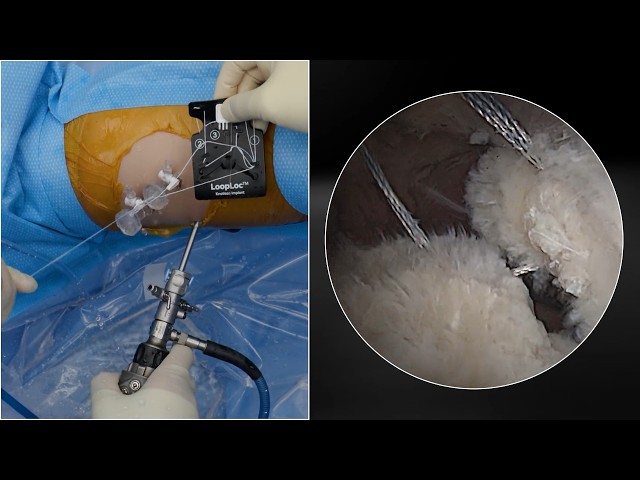 Hip Capsular Closure Using the SutureCast™ Suture Passer and LoopLoc™ Knotless Implant