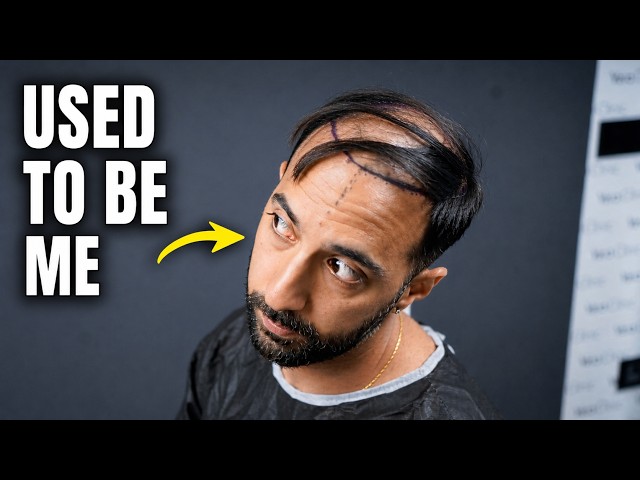 I got a hair transplant