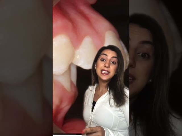 Different types of overbite! #dentist #braces #overbite #teethwhitening #orthodontist