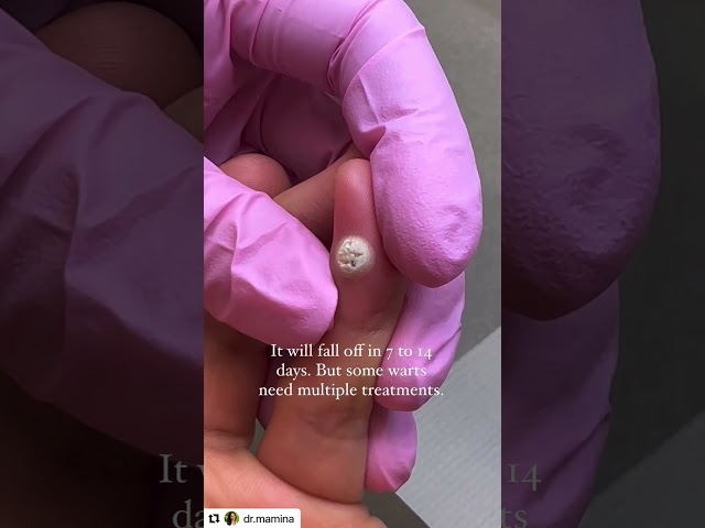 Freezing a Wart