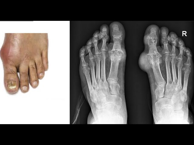 GENERAL PATHOLOGY 21: gout DR SAMEH GHAZY