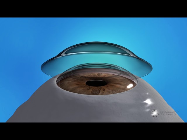 What Is Photorefractive Keratectomy (PRK)?