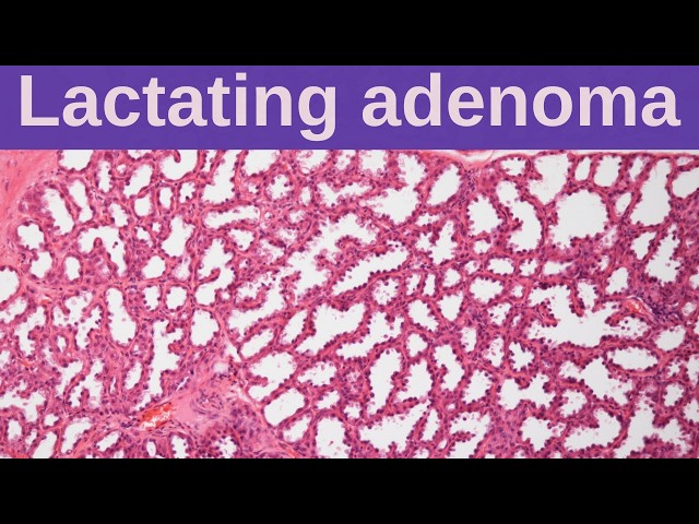 Lactating Adenoma - Pathology mini tutorials
