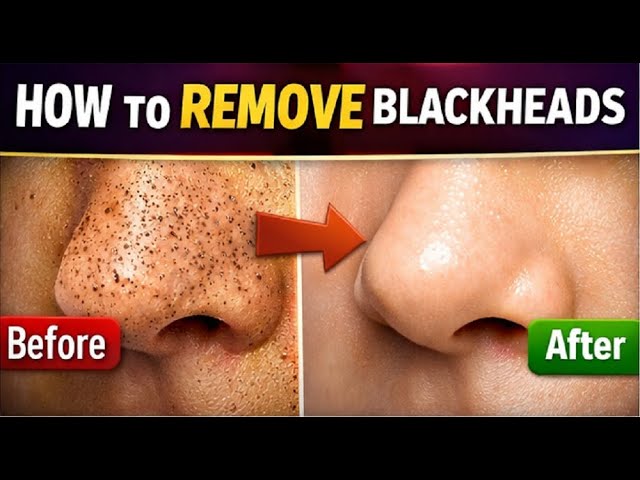 how to remove blackheads