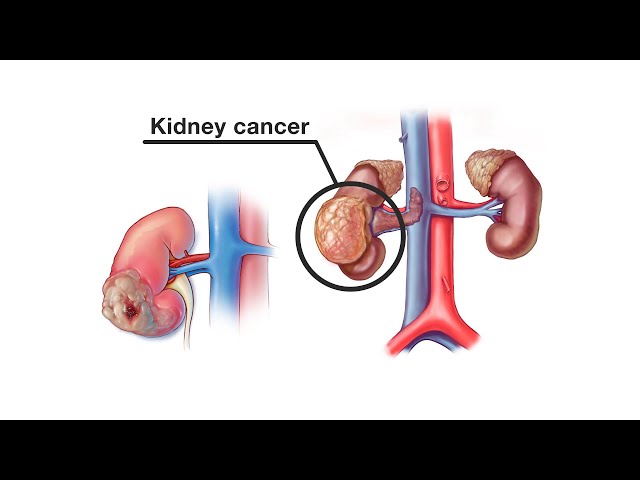 Mayo Clinic Minute - How is kidney cancer treated?