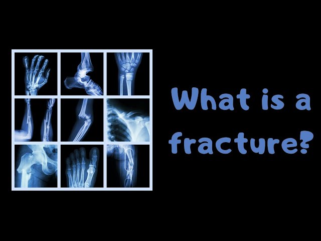What is a fracture?