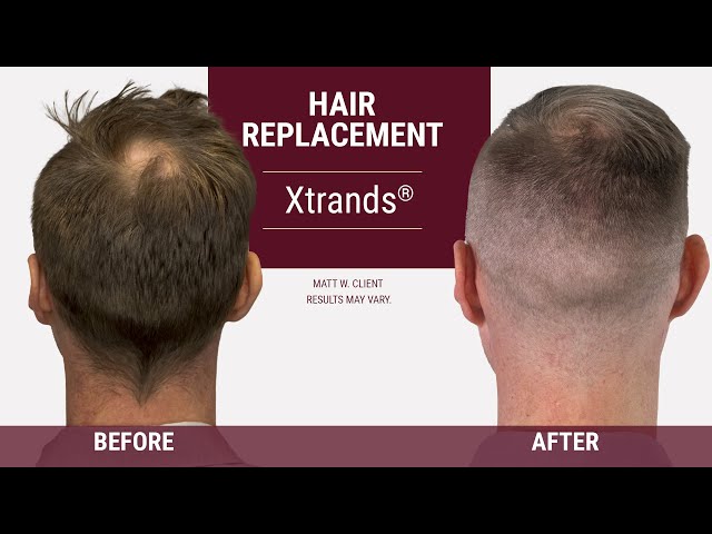 How to cover a bald spot on the back of your head [Hair Replacement]