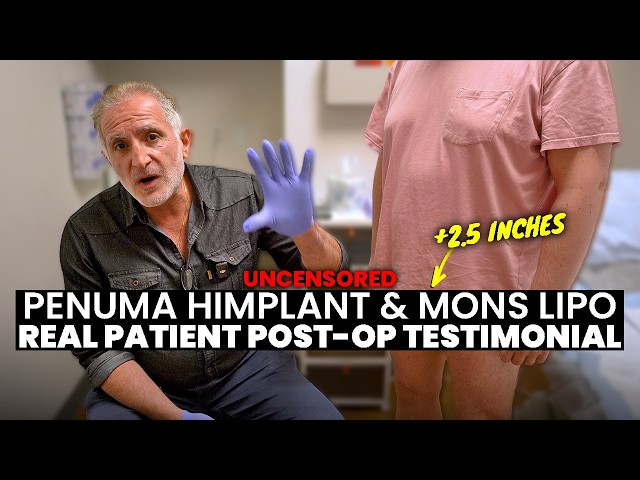 AMAZING! +2.5 INCHES with Penuma Himplant™ Implant and Mons Liposuction | Real Patient’s Testimonial