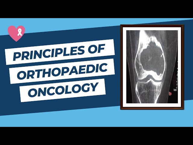 Principles of Orthopaedic Oncology and Bone Tumours for the FRCS Ortho Exam