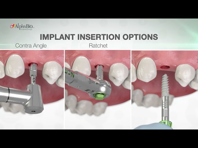 | Alpha-Bio Tec Implant Package