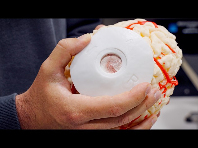 Our First Transdural Procedure | Neuralink