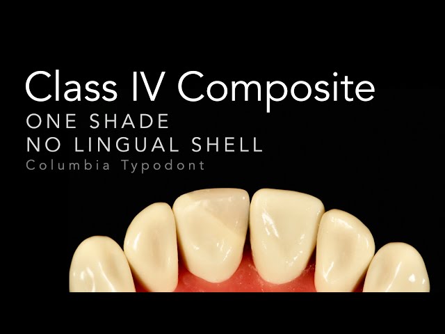 Class IV Composite Restoration | Step by Step One Shade Class IV Restorations
