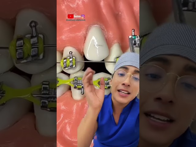 This is how braces are put on #shorts #dentist