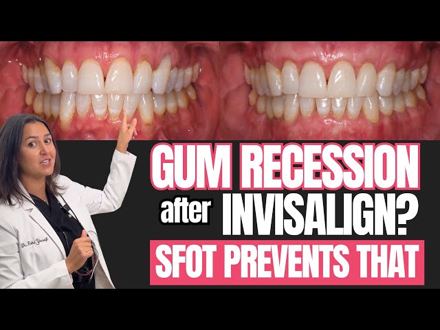 Did you have INVISALIGN and now have GUM RECESSION? SFOT prevents that from happening!