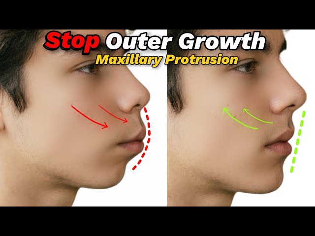 How To Stop Bio Maxillary Protrusion. The Outer Growth Of Facial Forward Pressure 