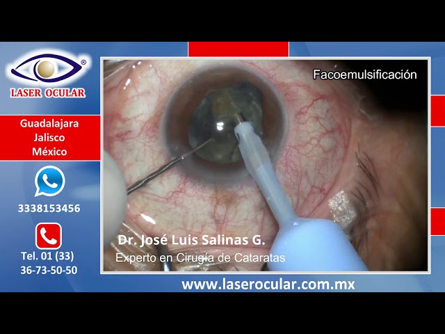 🥇 - Cataract Surgery with Ultrasound Phacoemulsification | OCULAR LASER ® - Eye Clinic