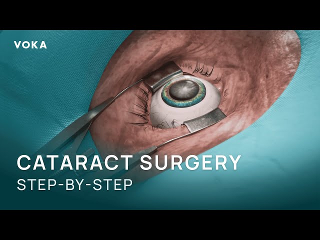 Cataract Surgery Explained in 3D: Phacoemulsification Step-by-Step