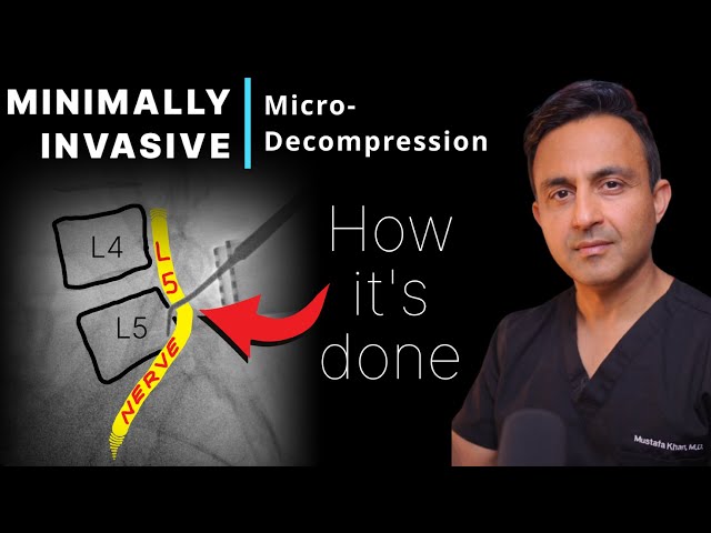 Micro-Decompression: A Minimally-Invasive Spine Surgery (Step-by-Step)