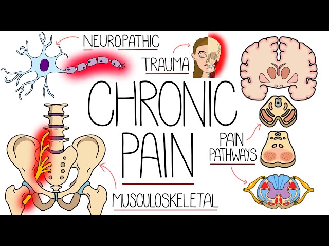 Understanding Chronic Pain (Including Treatment)