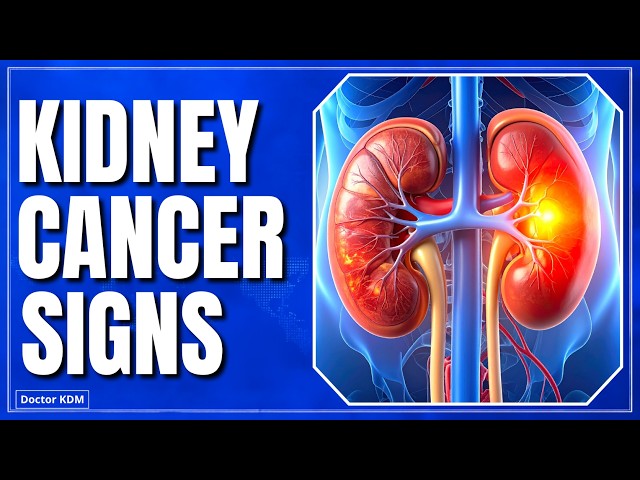 Kidney Cancer Is On the Rise, Here's What To Look For (Doctor Explains)