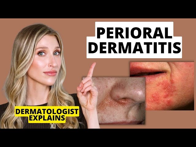 Dermatologist Explains Perioral Dermatitis (What it Looks Like, Causes, & Treatments) | Dr Sam Ellis