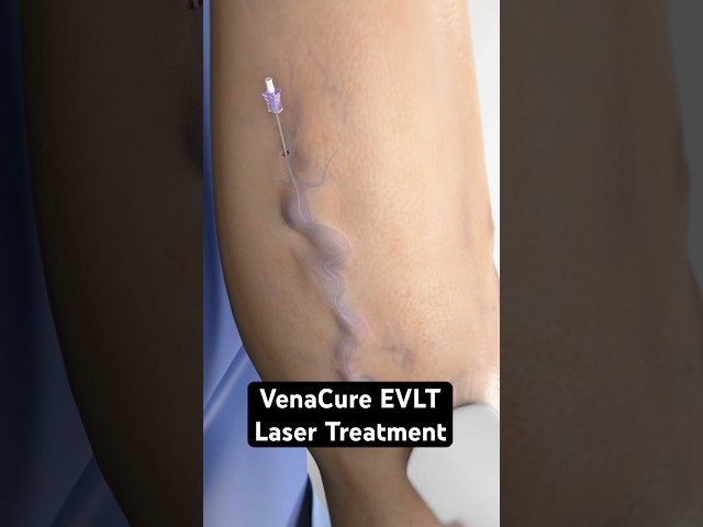 Using a laser to zap varicose veins (3D Animation)