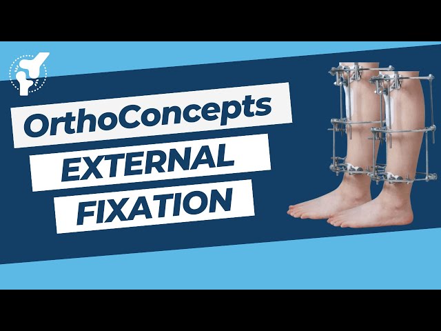 OrthoConcepts - Principles of External Fixation | Designs and Stability | Orthopedic Academy