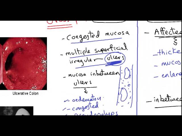 ULCERATIVE COLITIS AND CROHN'S DISEASE DR SAMEH GHAZY