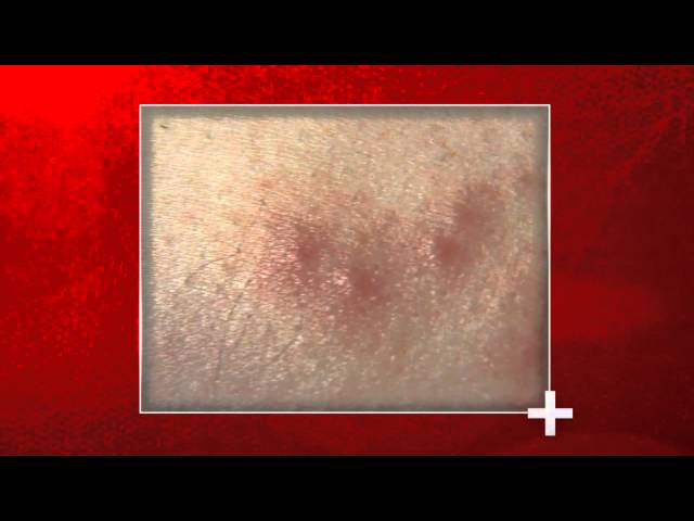 Bed Bug Bites: Signs & Health Impact | National Pest Management Association