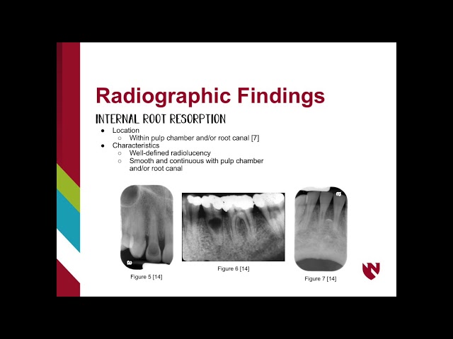 Internal or External Root Resorption