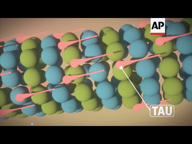 CTE: How Repeated Head Blows Affect the Brain