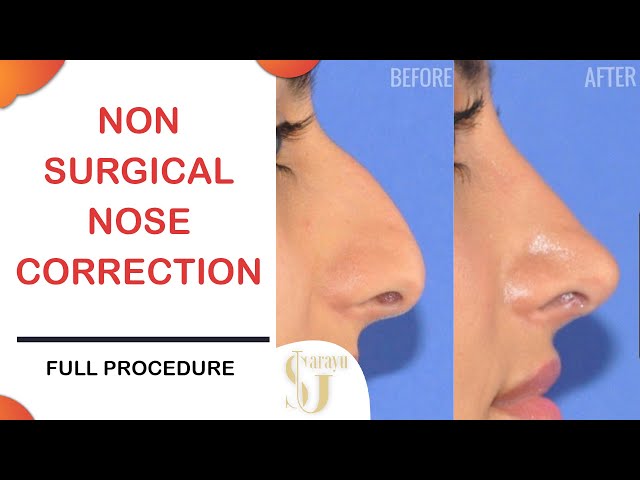 Non Surgical Nose Correction by Dr Adarsh Tripathi at Sarayu clinics